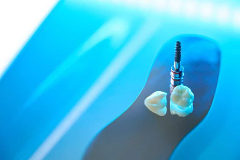 dental implants